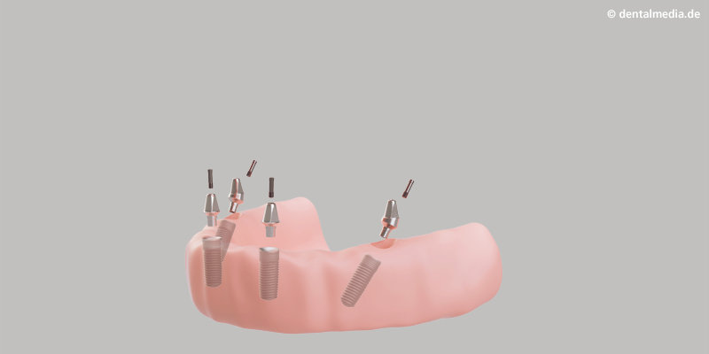 Befestigen der Aufbauten Unmittelbar nach dem Setzen der Implantate werden die Aufbauten, die das Provisorium tragen, befestigt.