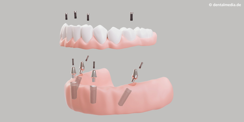 Aufschrauben des Provisoriums Die provisorische Versorgung wird, unmittelbar nach dem Eingriff, auf die Implantate geschraubt.