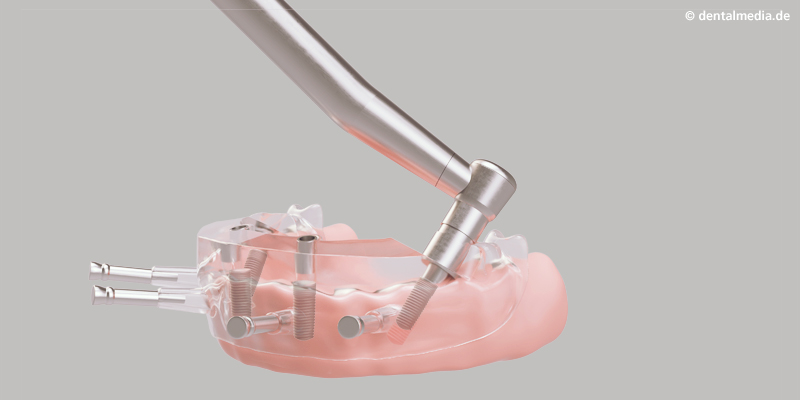 Schablonengeführte Implantatinsertion Präzise 3D-Planung: Mit Hilfe der  angefertigten OP-Schablone werden  die Implantate exakt eingefügt.