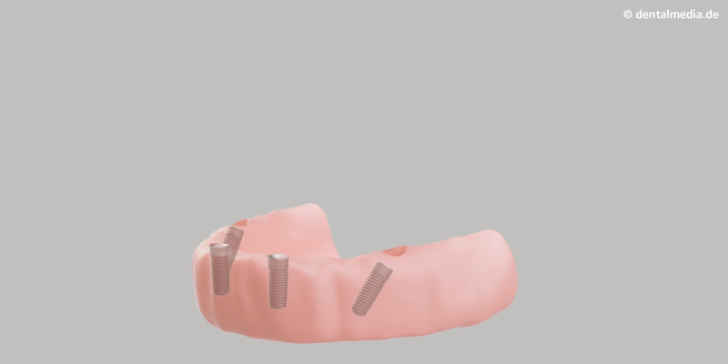 Einsetzen der Implantate Im vorderen Zahnbereich werden Implantate vertikal eingesetzt, im Hinteren in einen Winkel von bis zu 45°. So wird das Implantat fest im Kiefer verankert. Vorteil: extrem stabil und belastbar.